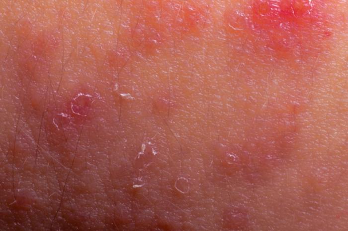 Eczema Causes Symptoms And Treatments Medical News Today 5671