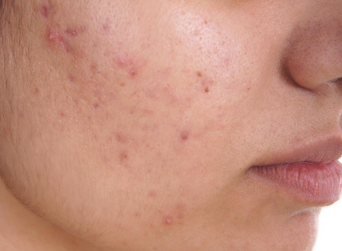 baby-acne-symptoms-causes-diagnosis-and-treatment-natural-health-news