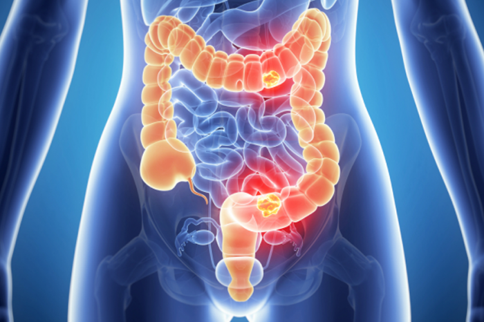 Fecal capsules resolve Clostridium difficile infection in