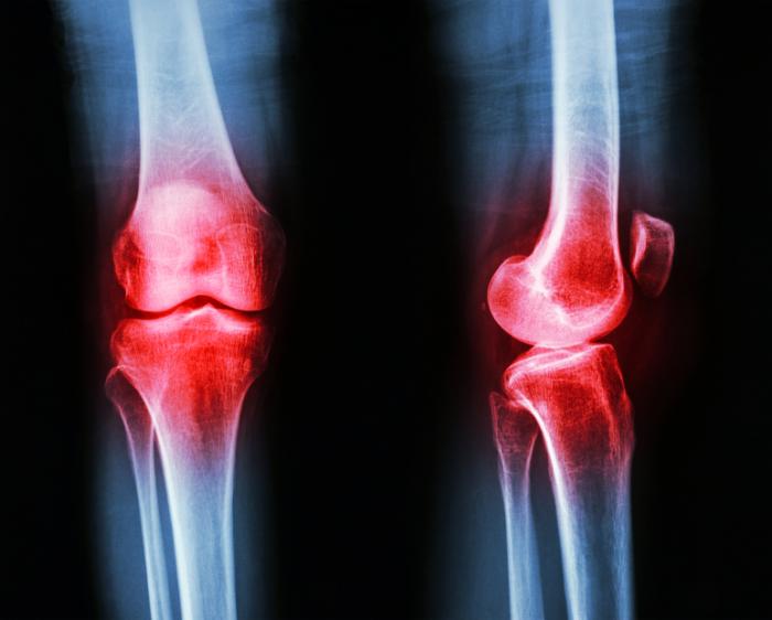 Hip Knee Replacement For Osteoarthritis Raises Risk Of Heart Attack