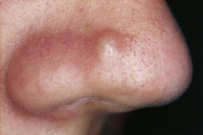 bumps-on-the-skin-pictures-causes-and-treatments-medical-news-today