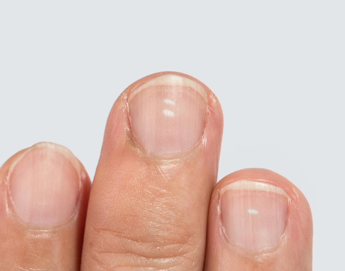 White Spots On Nails Causes Prevention And Treatment Medical News 