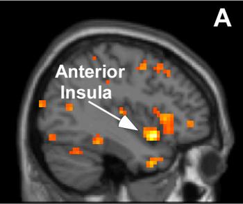 fMRI scan of HSP brain