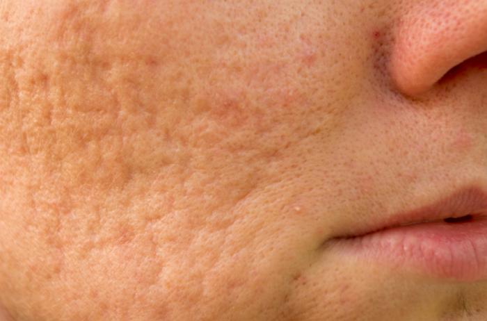 close up of acne scarring