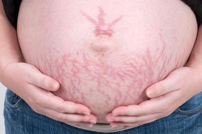 pregnant woman with stretch marks