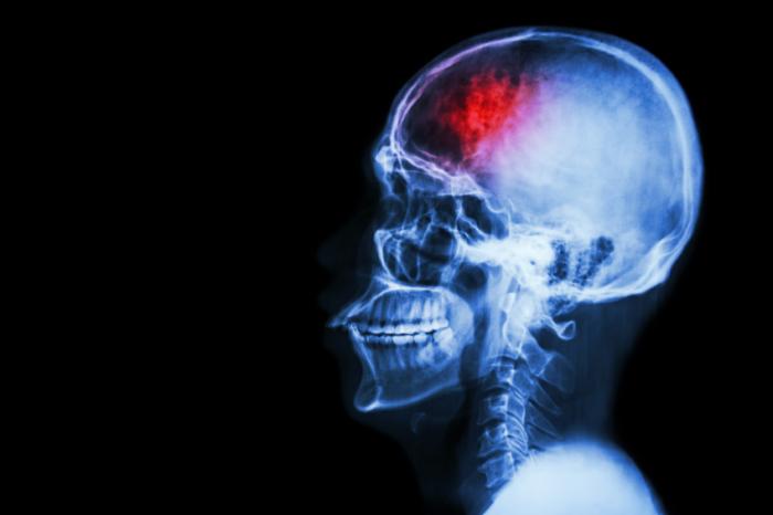 x ray of stroke patient