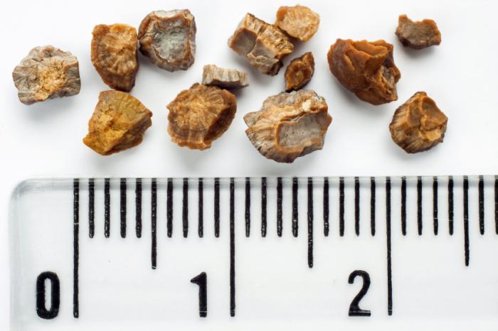 picture of kidney stones post-lithotripsy