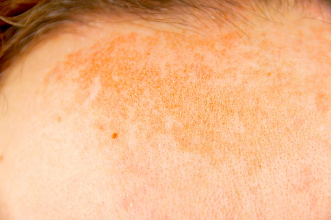 Acanthosis nigricans: Causes, symptoms, treatment, and pictures