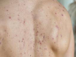 Infected pimple: Symptoms, diagnosis, and treatment