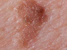 keratosis seborrheic treatment causes medicalnewstoday