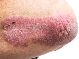 does psoriasis always itch
