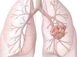 Lung cancer and cough: What is the connection?