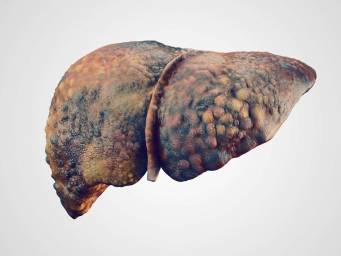 What's to know about alcoholic liver disease?