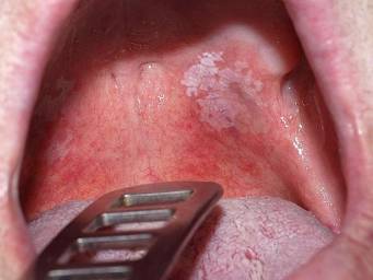 Mouth Cancer Symptoms Diagnosis And Treatment