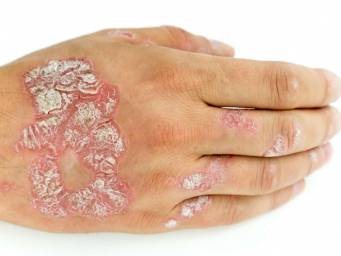 What are the different types of psoriasis?